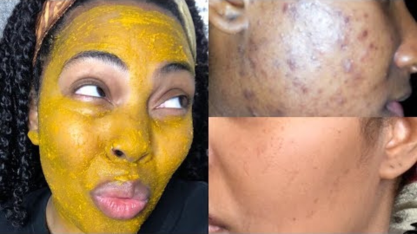 I Tried DIY Tumeric Mask For 3 Days And This Happened! My Skin Feels like a Baby’s Butt