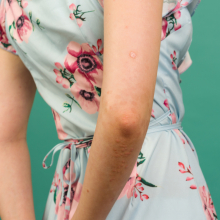 Ψωρίαση: Ποιες τροφές πρέπει να αποφεύγετε