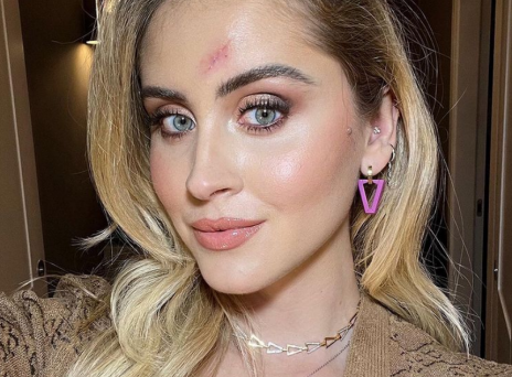 Η Valentina Ferragni με την ουλή στο πρόσωπο