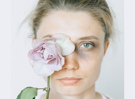 Κακοποιημένη γυναίκα με μελανιά στο μάτι