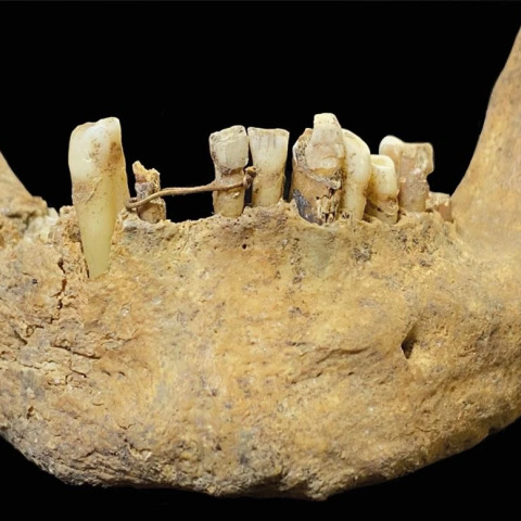 Βρέθηκε χρυσό σύρμα σε κρανίο 500 ετών - Η απίστευτη οδοντιατρική μέθοδος που ήρθε στο φως