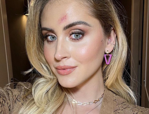 Η Valentina Ferragni με την ουλή στο πρόσωπο