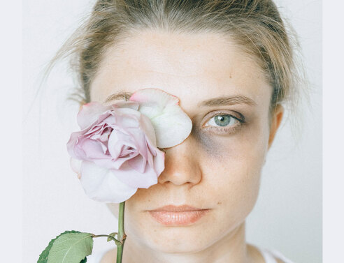 Κακοποιημένη γυναίκα με μελανιά στο μάτι