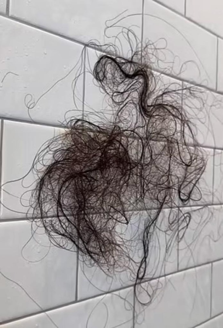 Τα χαμένα μαλλιά της Σοφία Ουμάνσκι μετά τη δίαιτα και την παράλληλη λήψη Mounjaro 